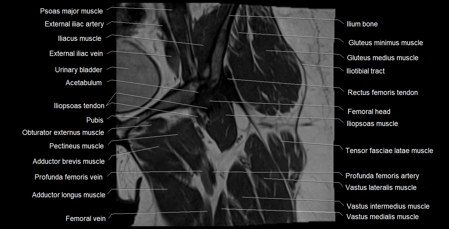 MRI Hip 3T coronal cross sectional anatomy image 20.webp